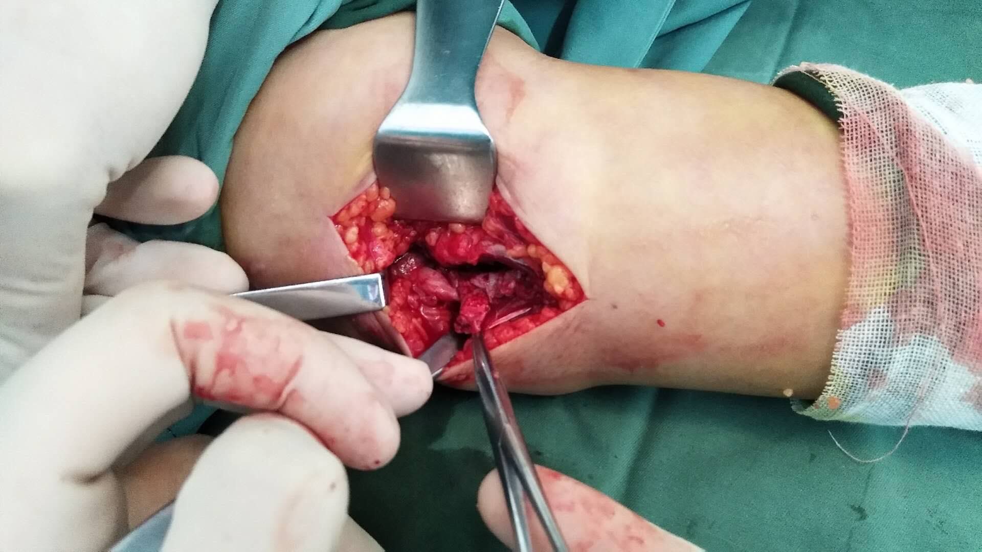 肱骨内髁屈肌腱总止点撕脱性骨折止点重建尺神经松解