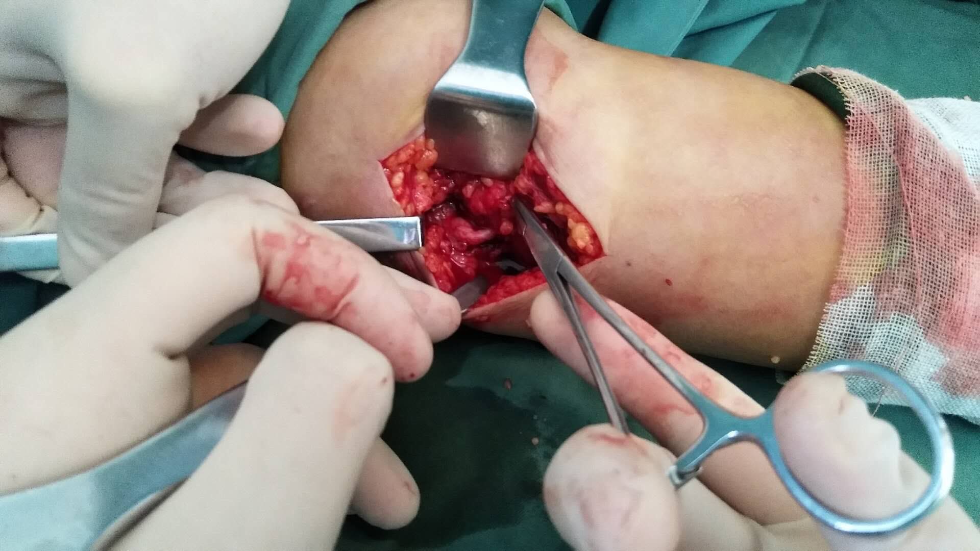 肱骨内髁屈肌腱总止点撕脱性骨折止点重建尺神经松解