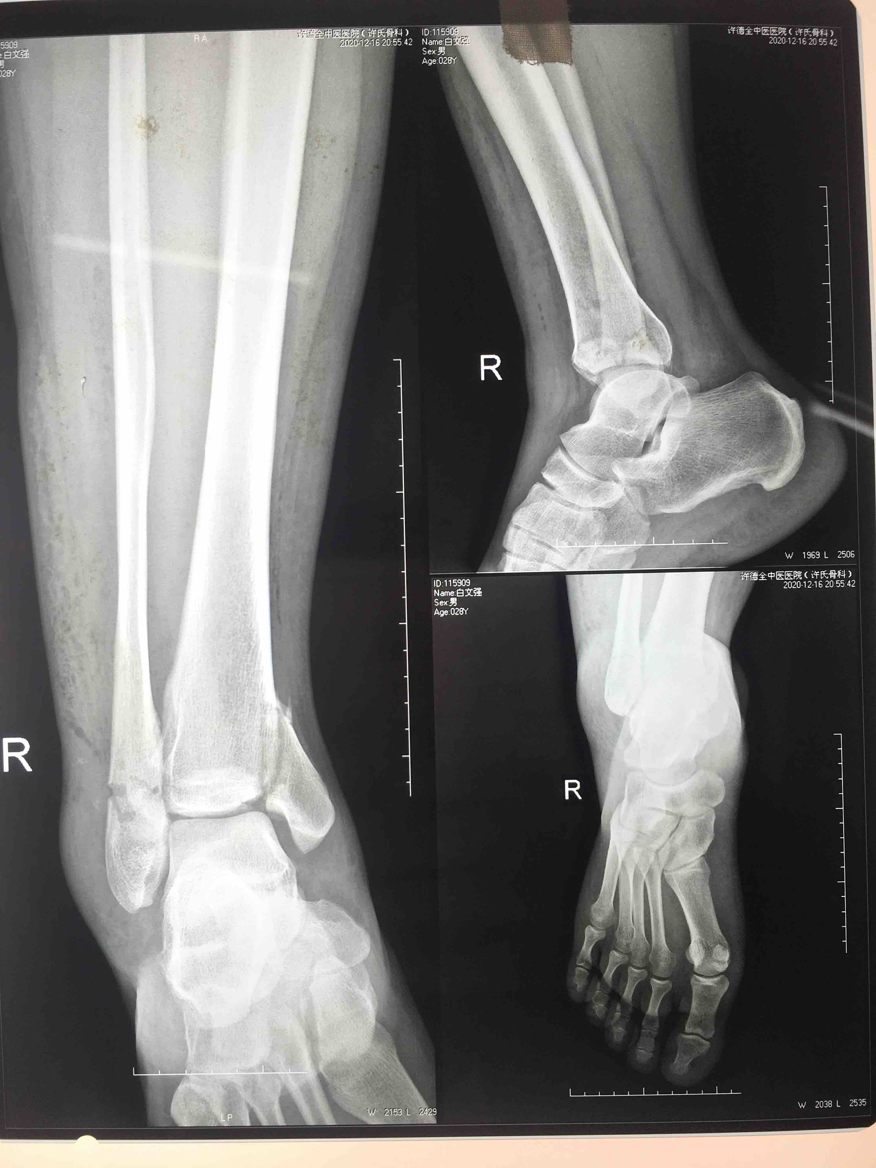 2种不同手术方法治疗陈旧性踝关节骨折合并下胫腓联合损伤的对比