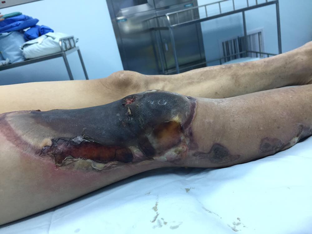 关于烧伤后股四头肌缺失的后期保肢治疗