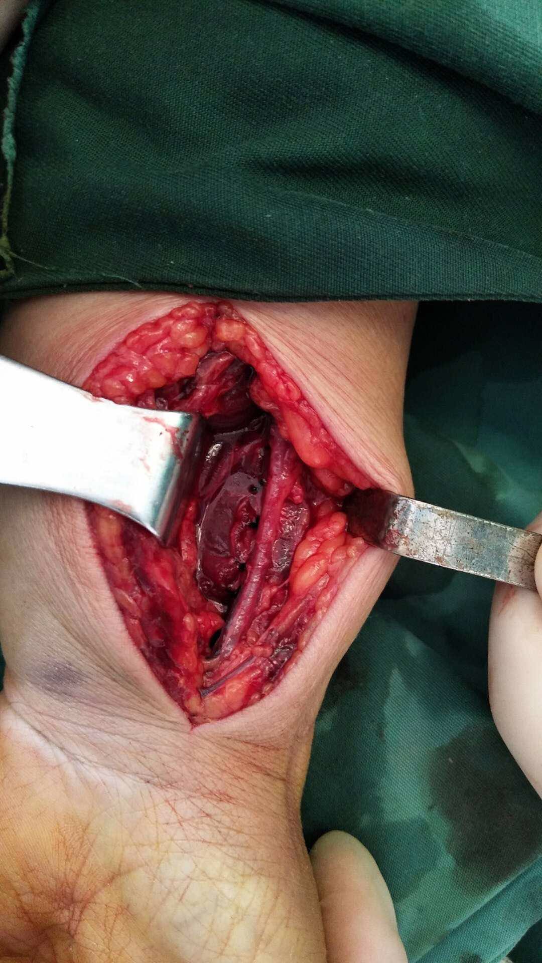 局部皮温皮色基本正常,压痛及纵向叩击痛阳性,可及骨擦音及骨擦感