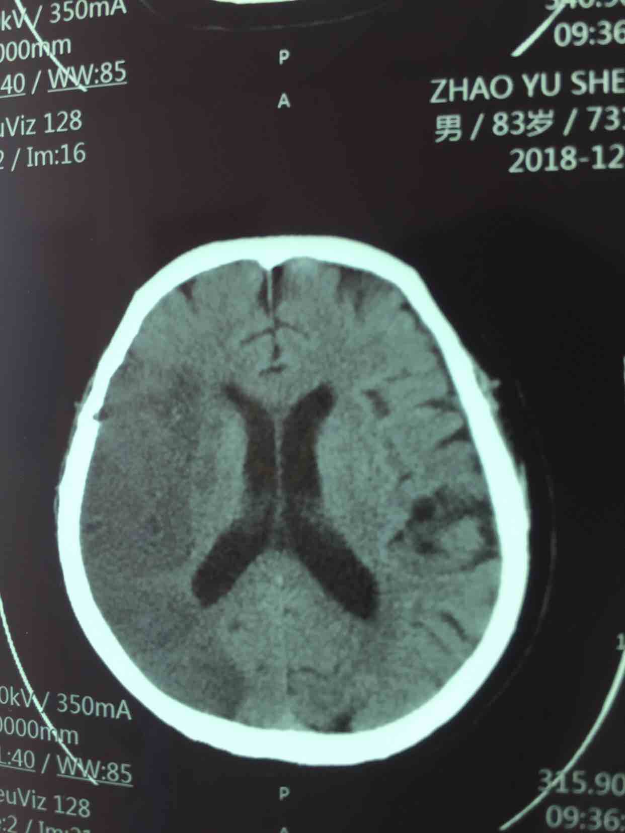 超急性期大面积脑梗死 CT 平扫表现-搜狐大视野-搜狐新闻