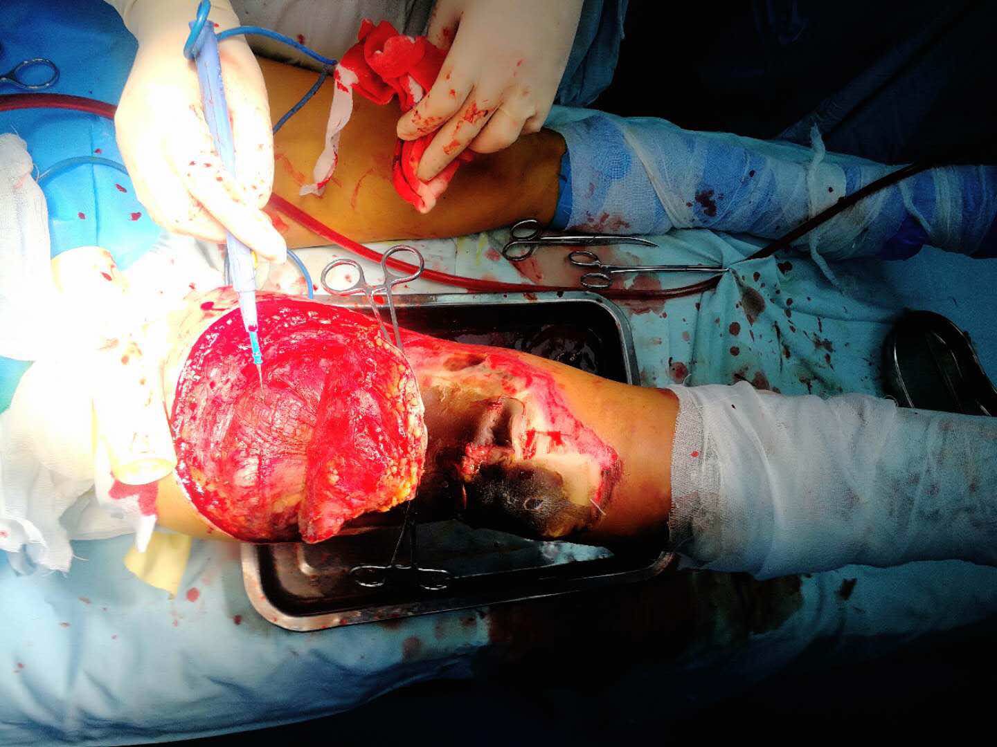 关于烧伤后股四头肌缺失的后期保肢治疗