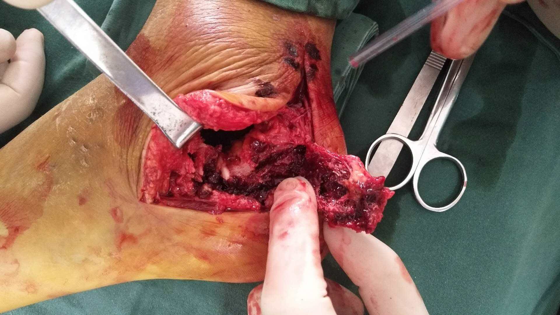 双跟骨粉碎性骨折(切复内固定术)-医联