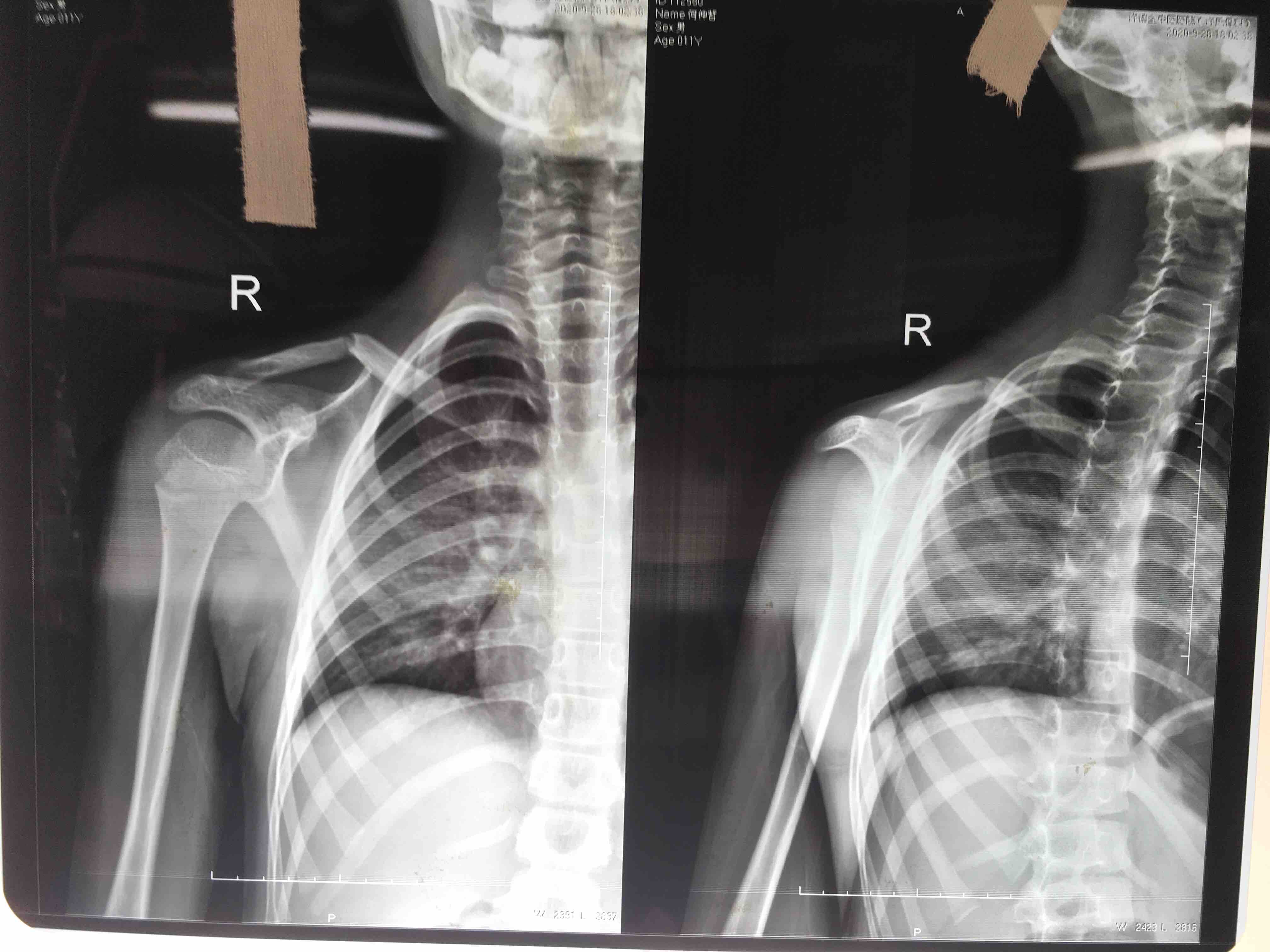 儿童锁骨骨折手术治疗（大于12岁） - 微医（挂号网）